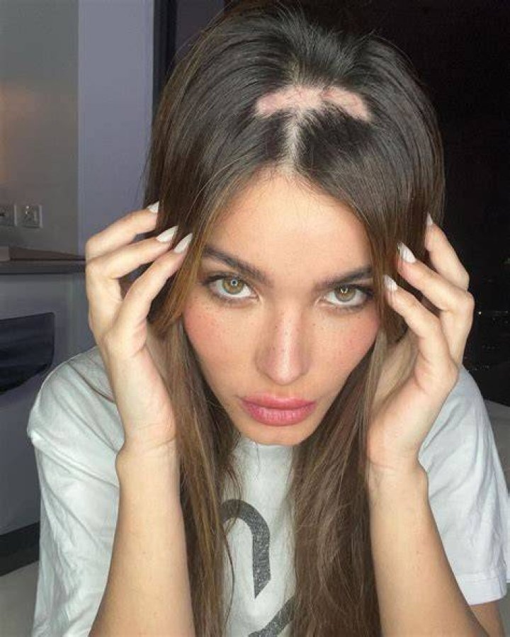 Aleska G&eacute;nesis tiene alopecia por qu&eacute; se le est&aacute; cayendo el pelo a la