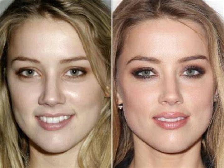 Amber Heard plastic surgery TikTok plastic surgeon reveals Johnny Depp