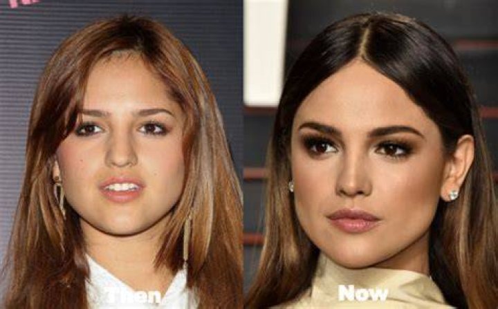 BEFORE AND AFTER Eiza gonzalez, Celebrity skin, Face fillers