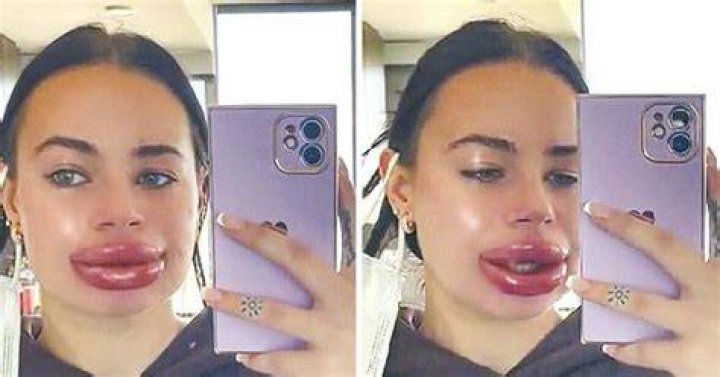 Botched Lip Filler Injection Has Influencer Speaking Out Mystical Raven