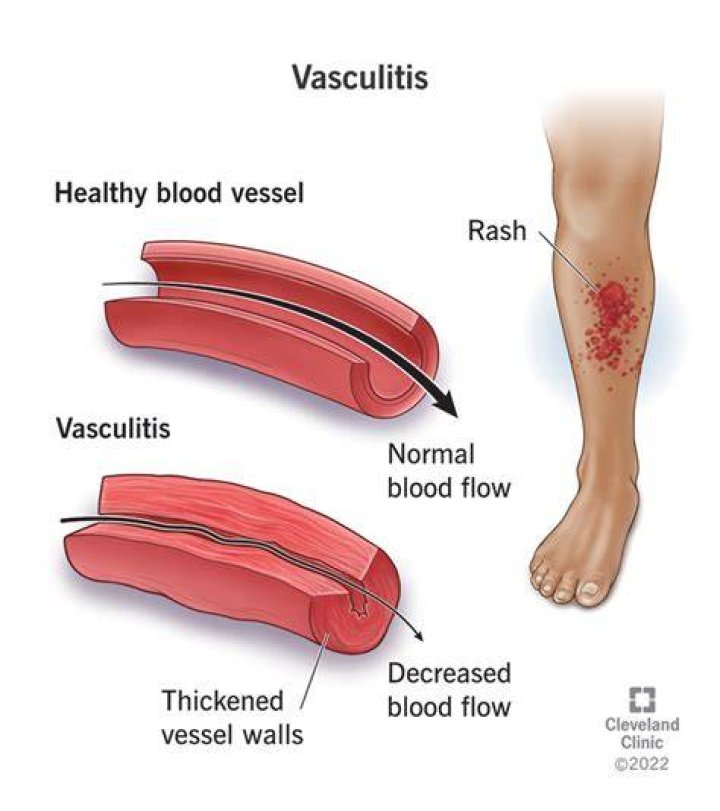 Cause Of Death Vasculitis The Celebrity Deaths vrogue.co