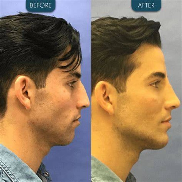 Chin Implant Before & After Pics Celebs with Sharp Jawline NewBeauty