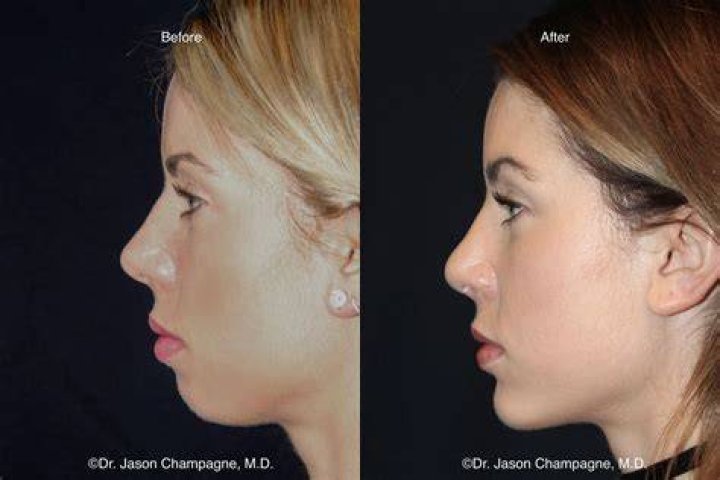 Chin Implant before and afters, perfect celebrity jawlines Celebrity