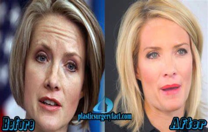 Dana Perino Before And After Plastic Surgery