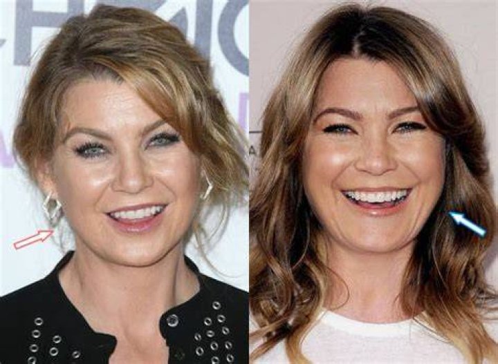 Ellen Pompeo facelift before and after Facelift before and after