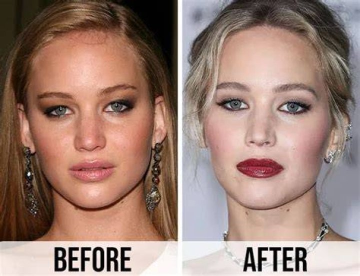 Has Jennifer Lawrence had Cosmetic Surgery? MYA Cosmetic Surgery