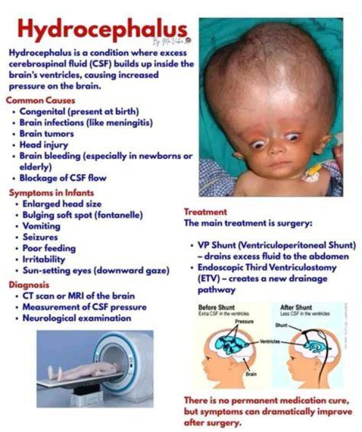 Hydrocephalus Symptoms Explained As Nick Cannon's 5MonthOld Son Zen