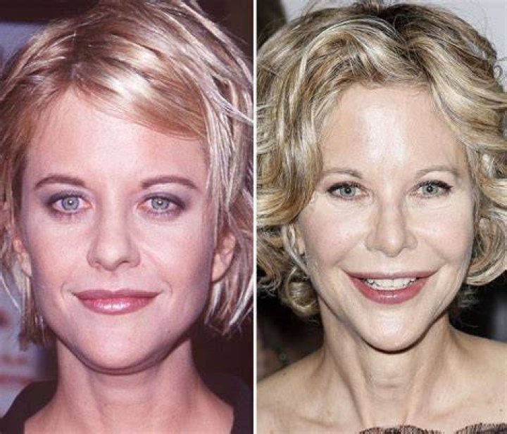 Meg Ryan Plastic Surgery Before and After Pictures 2021