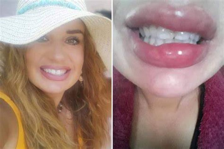NHS worker branded a &lsquo;monster&rsquo; after botched filler made her lips