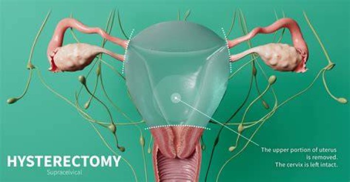 Operation Hysterectomy Charlotte Hunter Menopause Nutritionist