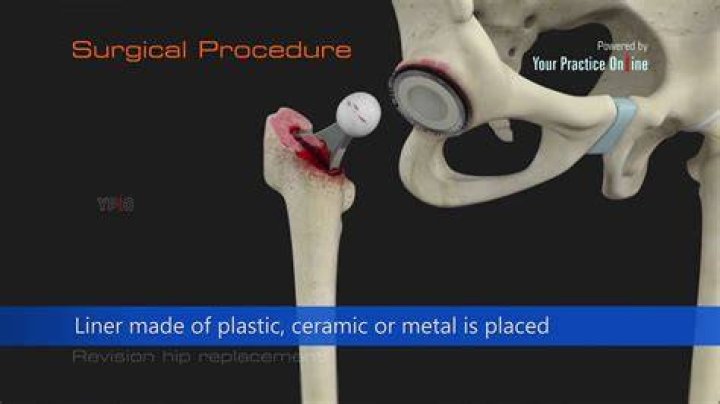 Pamela Morton Hip Replacement YouTube