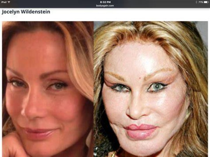 Pin on Celebrity plastic surgery before and after photos