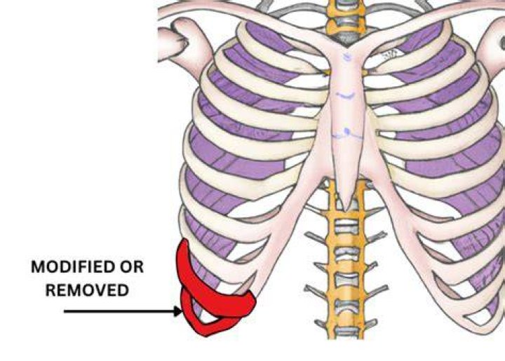 Rib Removal Plastic Surgery Before And After