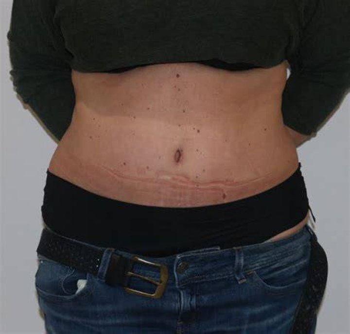 Tummy Tuck (Abdominoplasty) The Karri Clinic