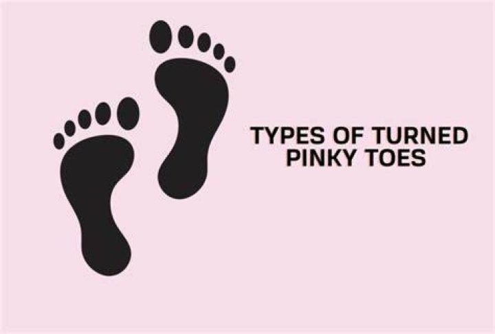 Unraveling The Mystery Of Sideways Pinky Toes