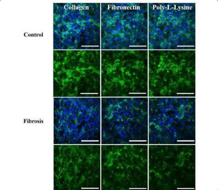ZO1 expression in Liver MPS and liver fibrosisonchip with different